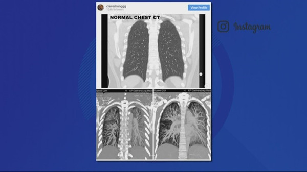 一位少年在Instagram上发布肺部CT扫描，显示电子烟带来的影响