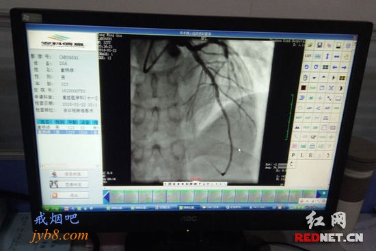 33岁男子喜熬夜抽烟突发心梗 称出院后戒烟早睡