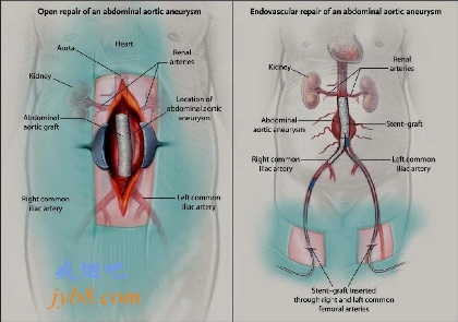 吸烟者患腹主动脉瘤的可能性更大