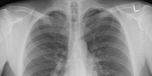 最新研究：长期每日电子烟使用不损伤肺部