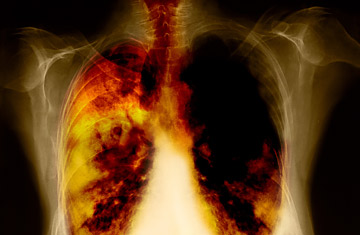 lung_cancer_0328.jpg