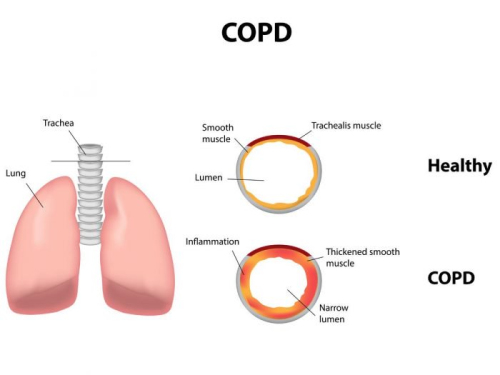 在澳大利亚模型研究预测COPD的共同因素：吸烟