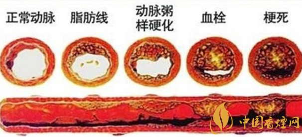 吸烟容易引起哪种疾病 吸烟对心血管的危害(重创血管壁十年难修复了)