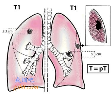 吸烟者和非吸烟者患上非小细胞肺癌的临床特征和生存率存在显著差异