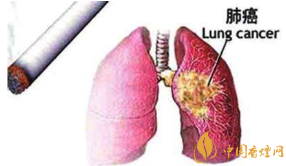 吸烟与肺癌的关系研究 与吸烟关系最为密切的肺癌是鳞癌
