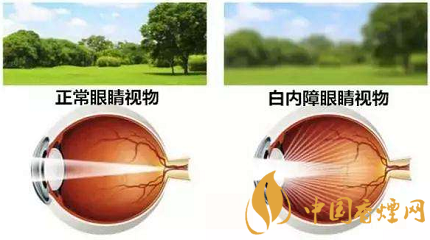 吸烟对眼睛的6大危害 抽烟的你一定要看！